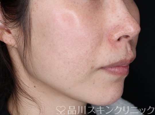 症例NO.64148のAFTER写真