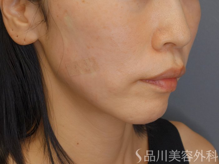 症例NO.72059のAFTER写真