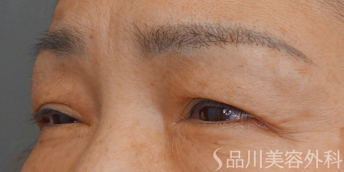 症例NO.72861のBEFORE写真