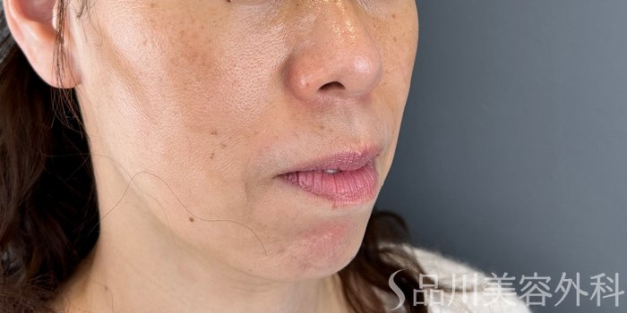 症例NO.72835のBEFORE写真