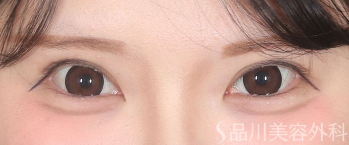 症例NO.73570のAFTER写真