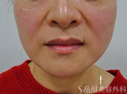 症例NO.73698のBEFORE写真