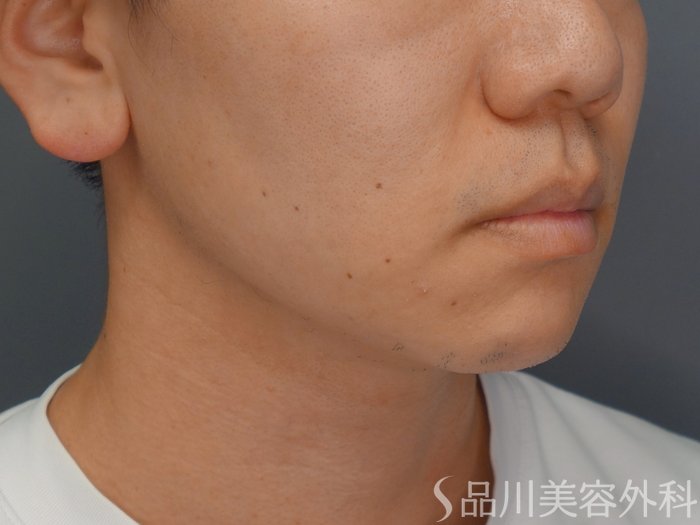 症例NO.67323のBEFORE写真