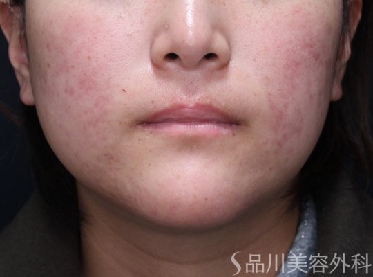 症例NO.73012のAFTER写真