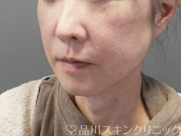 症例NO.73024のBEFORE写真