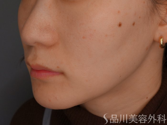 症例NO.73627のBEFORE写真