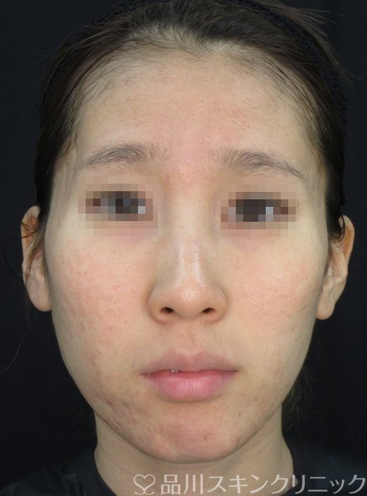 症例NO.72056のAFTER写真