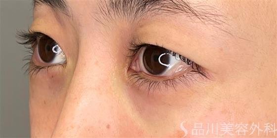 症例NO.50482のAFTER写真