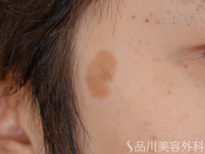 症例NO.68938のBEFORE写真