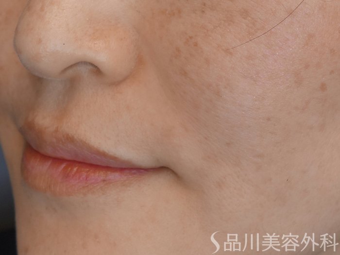症例NO.68201のAFTER写真