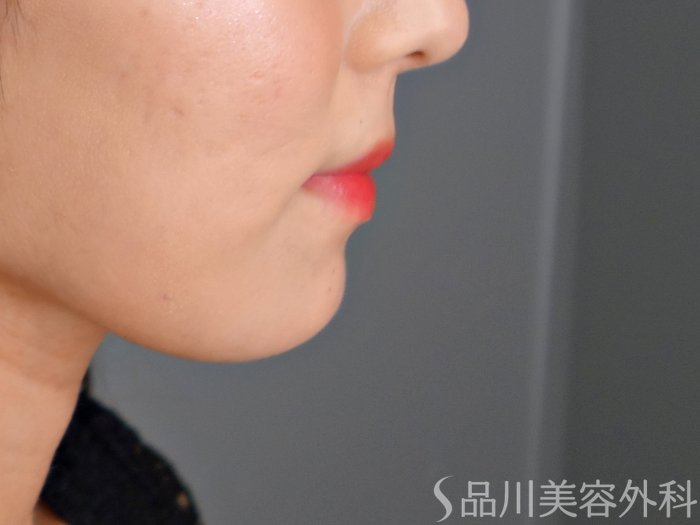 症例NO.70715のBEFORE写真