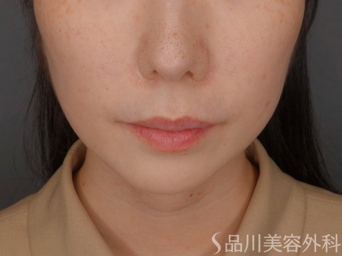 症例NO.62465のBEFORE写真