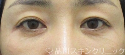 症例NO.65713のBEFORE写真