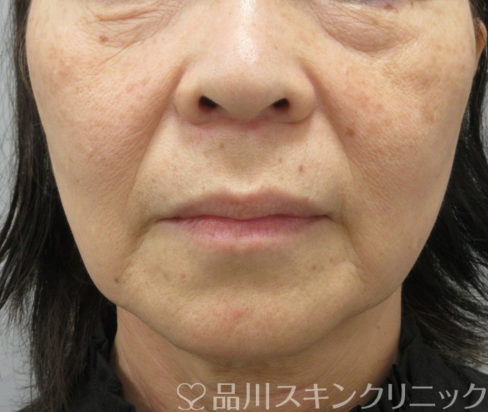 症例NO.74802のBEFORE写真
