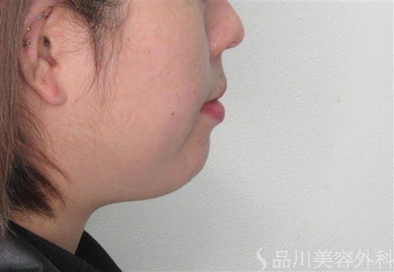 症例NO.52873のBEFORE写真