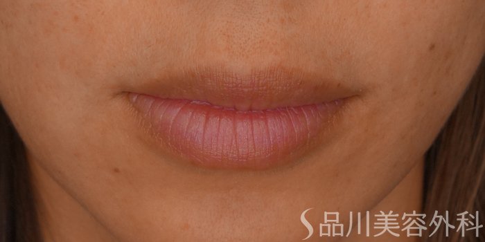 症例NO.67903のBEFORE写真