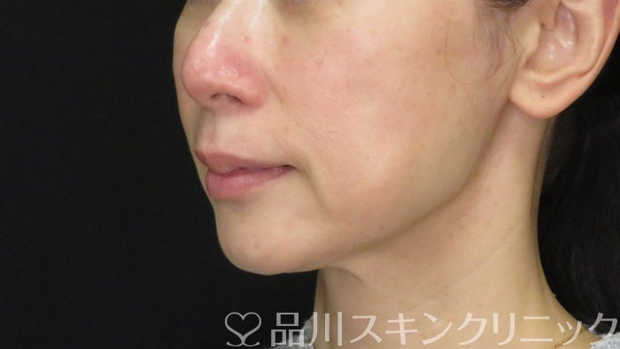 症例NO.72501のBEFORE写真