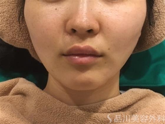 症例NO.24565のAFTER写真