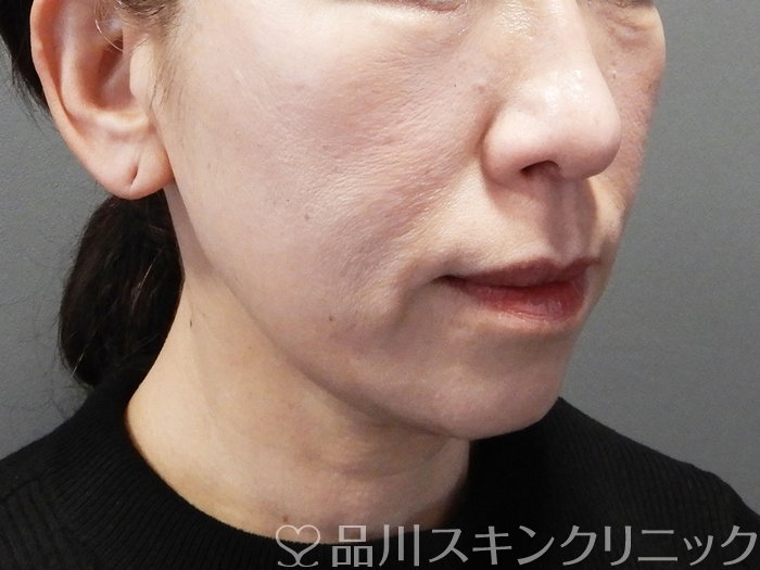 症例NO.73575のAFTER写真