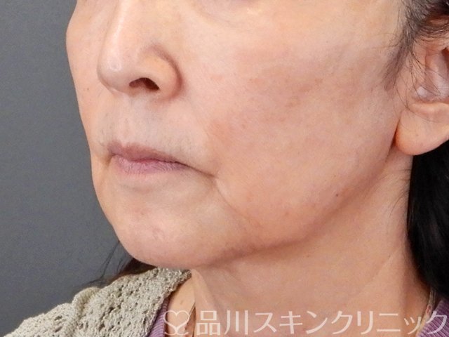 症例NO.75299のBEFORE写真