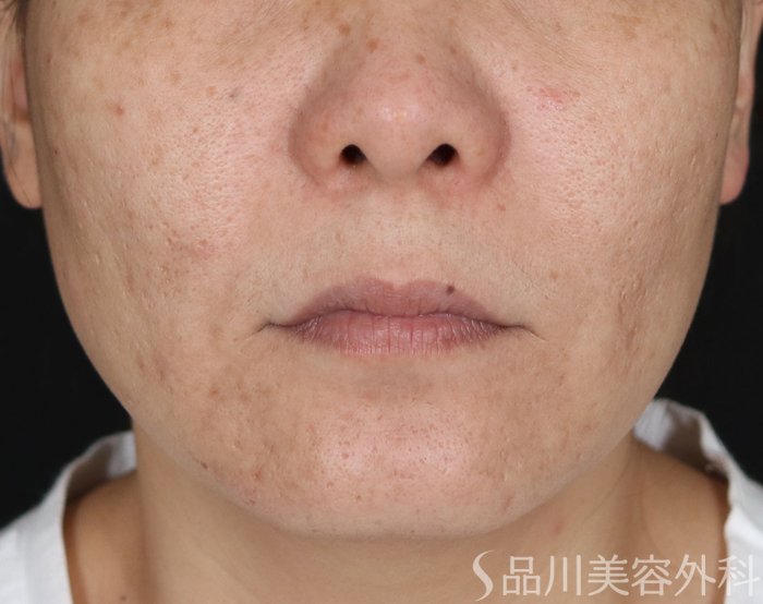 症例NO.70936のBEFORE写真
