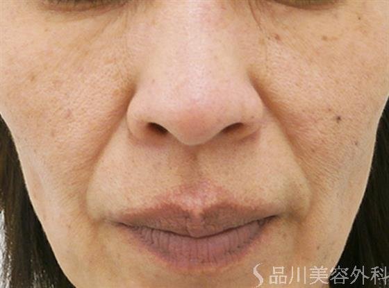 症例NO.23671のAFTER写真