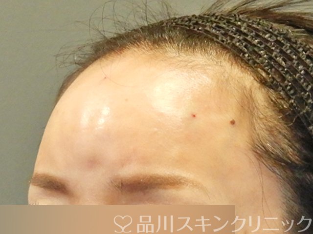 症例NO.66431のAFTER写真