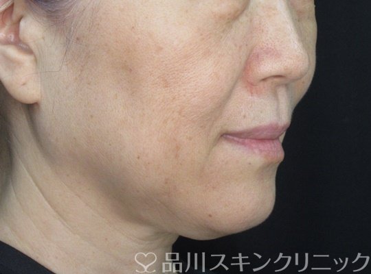 症例NO.71218のBEFORE写真