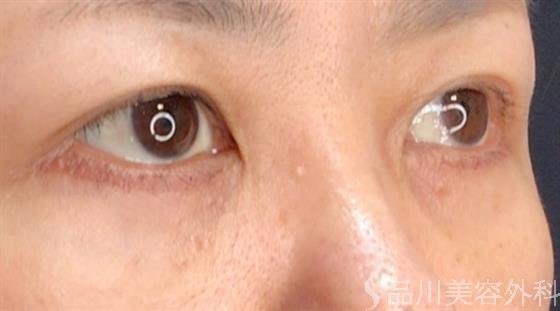 症例NO.59176のAFTER写真
