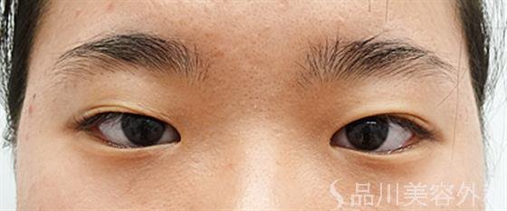 症例NO.46062のBEFORE写真