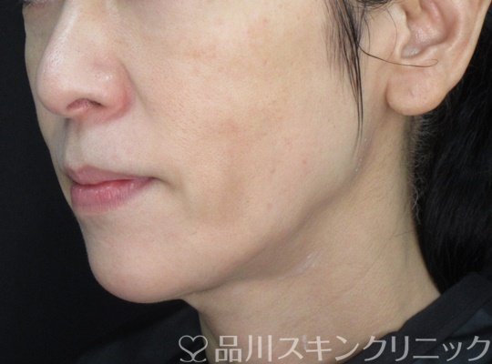 症例NO.71866のAFTER写真