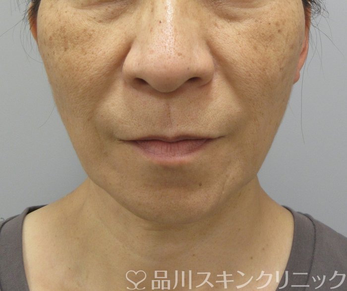 症例NO.73925のBEFORE写真