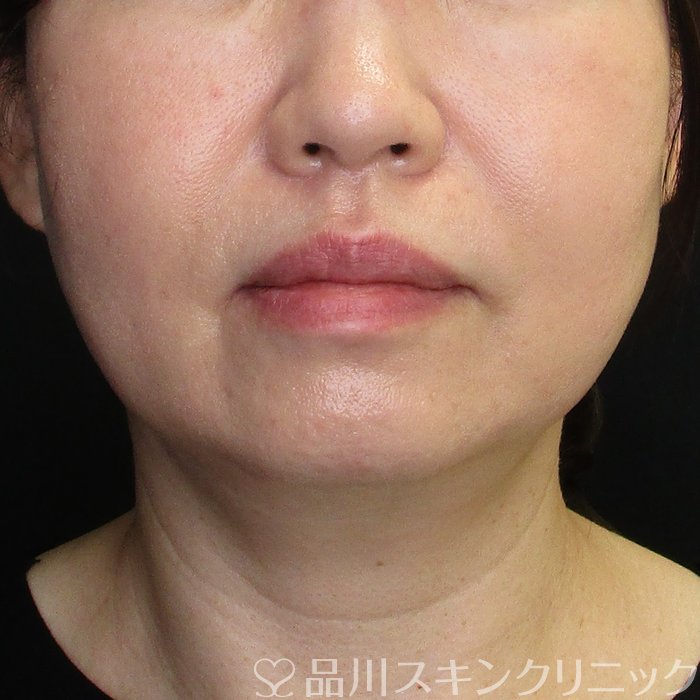 症例NO.62433のBEFORE写真