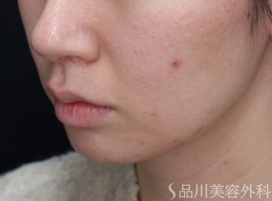 症例NO.73624のBEFORE写真