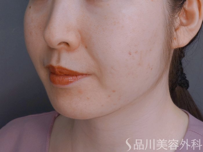 症例NO.74067のAFTER写真