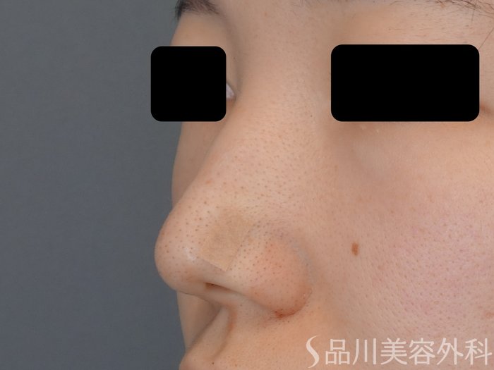 症例NO.70145のAFTER写真
