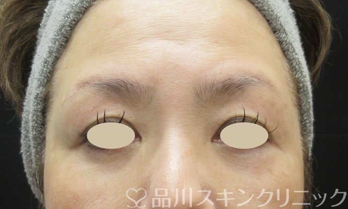 症例NO.69364のAFTER写真