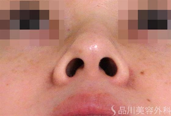 症例NO.38088のBEFORE写真