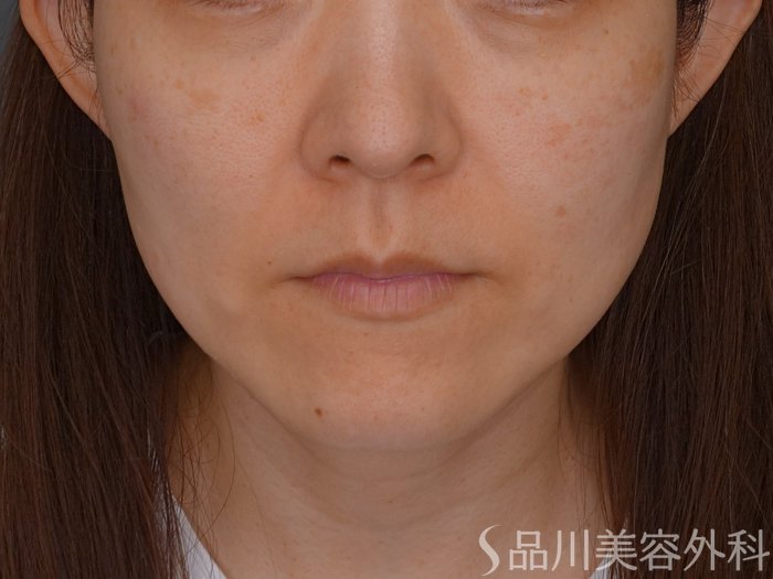 症例NO.74791のBEFORE写真