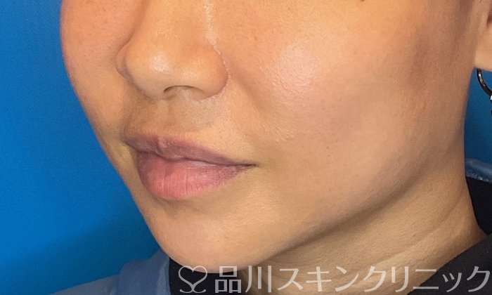 症例NO.74486のBEFORE写真