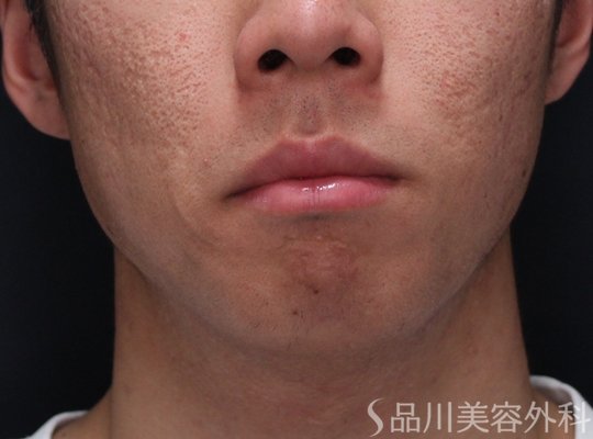 症例NO.72982のAFTER写真