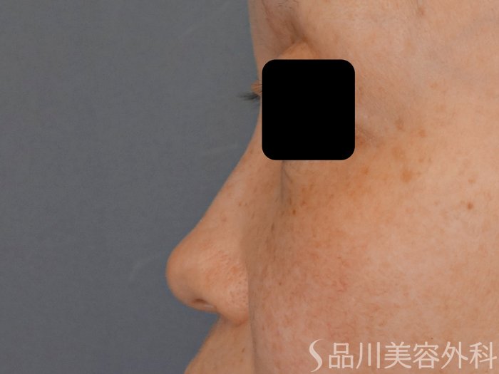 症例NO.69629のBEFORE写真