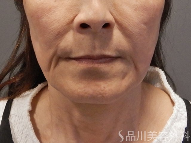 症例NO.71868のBEFORE写真