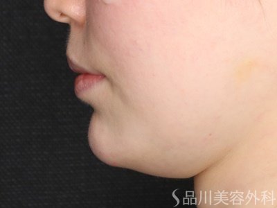 症例NO.72807のAFTER写真