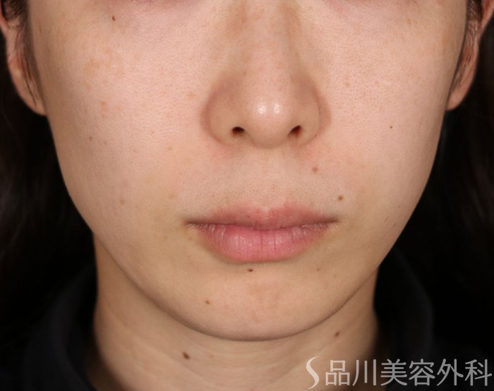 症例NO.72534のBEFORE写真