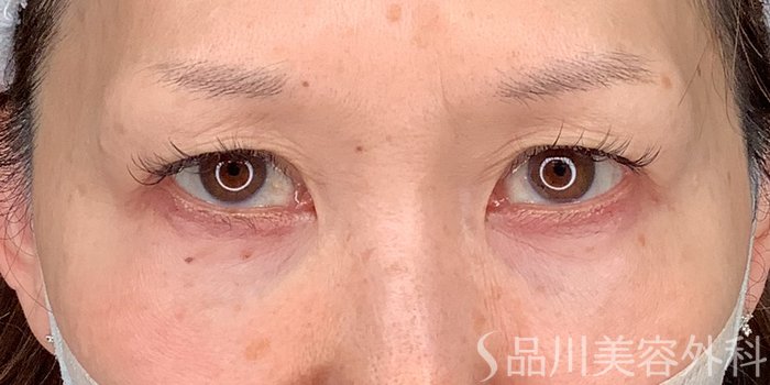 症例NO.71230のBEFORE写真