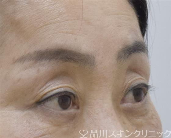 症例NO.59006のBEFORE写真