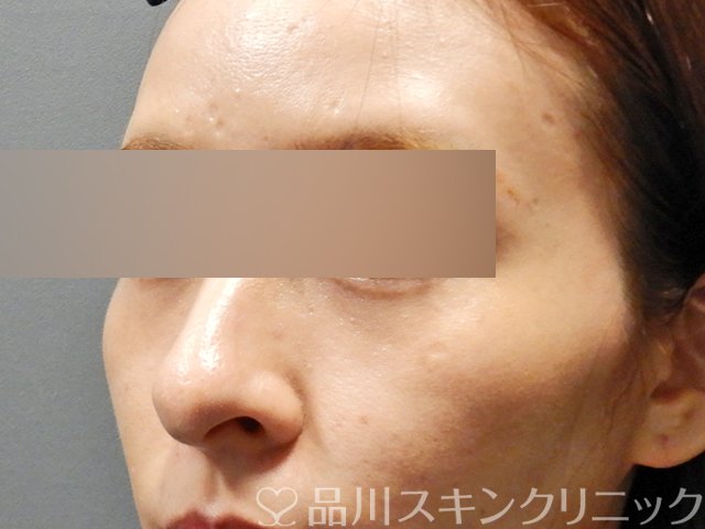 症例NO.67974のBEFORE写真
