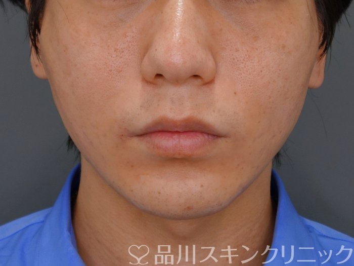 症例NO.73823のAFTER写真