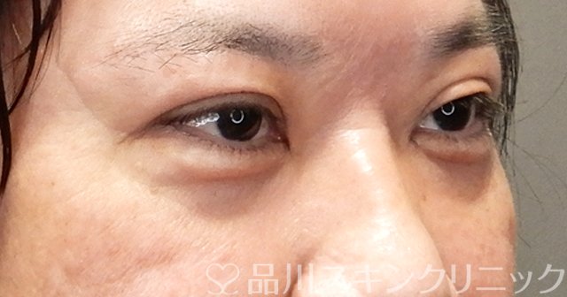 症例NO.68463のAFTER写真